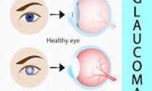 青光眼中医辩证的可能病因，治疗可用的伤寒论经方、针炙的穴位及其他可用的中医治疗方法